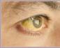 Жовтизна під очима: причини виникнення та особливості лікування